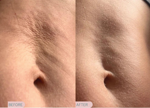Juvenate ReSculpt Body Treatment